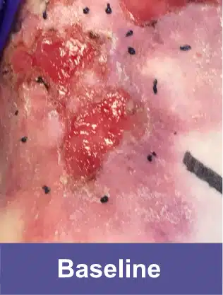 Shoulder blade of a VYJUVEK® patient before treatment