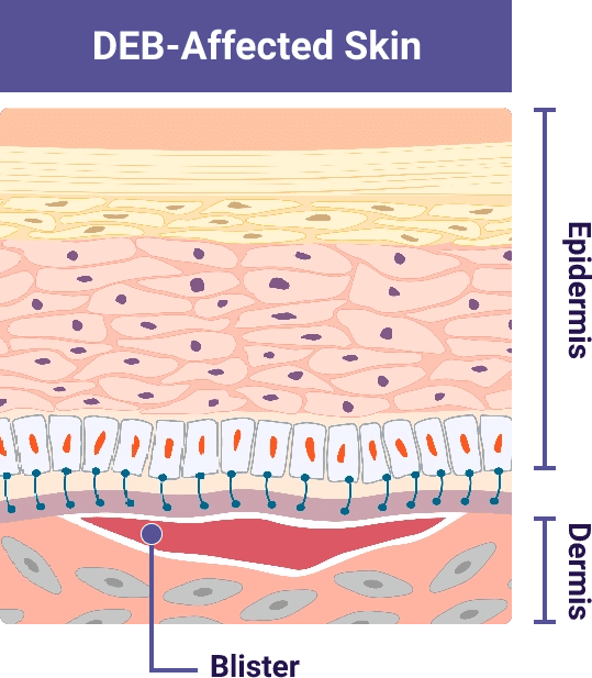 Skin affected by DEB