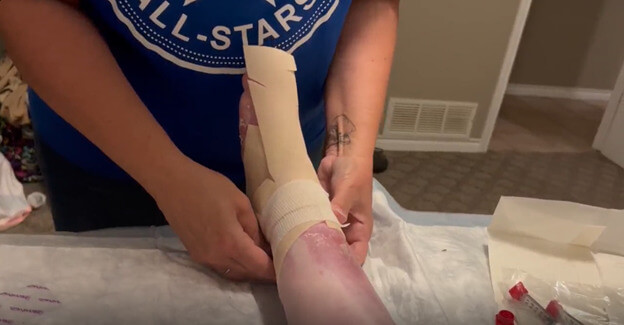 Emily's foot being wrapped