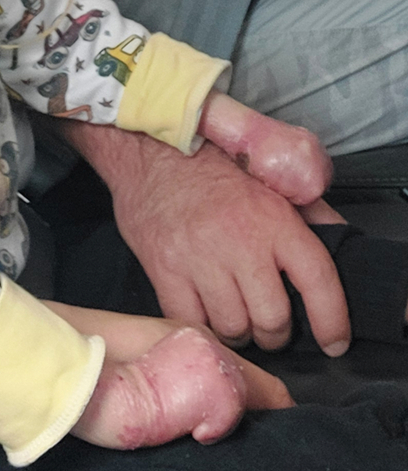 Pre-Surgery