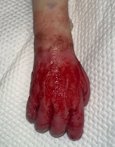 Post-surgery