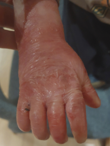 After treatment with VYJUVEK