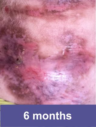 Abdomen of a VYJUVEK™ patient after treatment