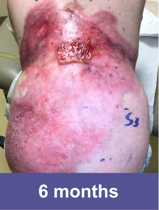 A wound on back of a VYJUVEK™ patient after 6 months of treatment