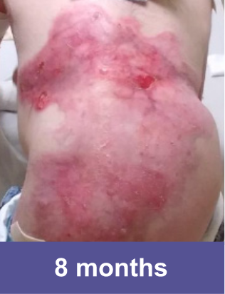 A wound on back of a VYJUVEK™ patient after 8 months of treatment