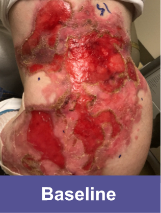 A wound on back of a VYJUVEK™ patient before treatment