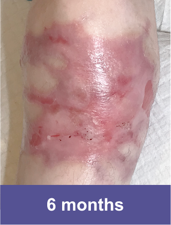Knee of a VYJUVEK™ patient after treatment