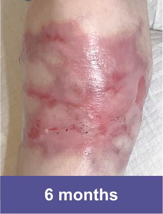 Knee of a VYJUVEK™ patient after treatment