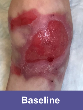 Knee of a VYJUVEK™ patient before treatment