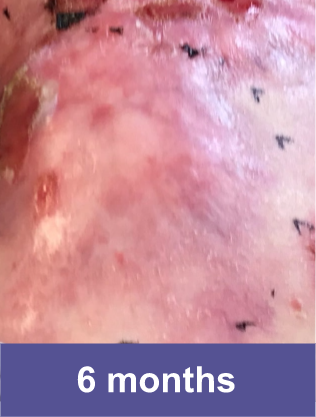 Shoulder blade of a VYJUVEK™ patient after treatment